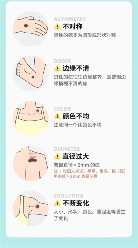 胸部長很多痣|痣也可能会癌变！长在 3 个地方要注意